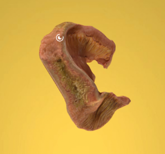 回肠淋巴肉瘤