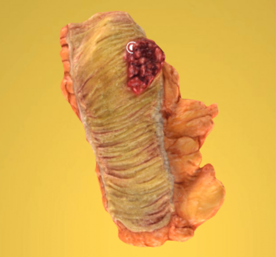 结肠绒毛息肉