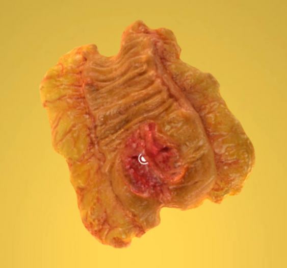 结肠腺癌伴无节息肉