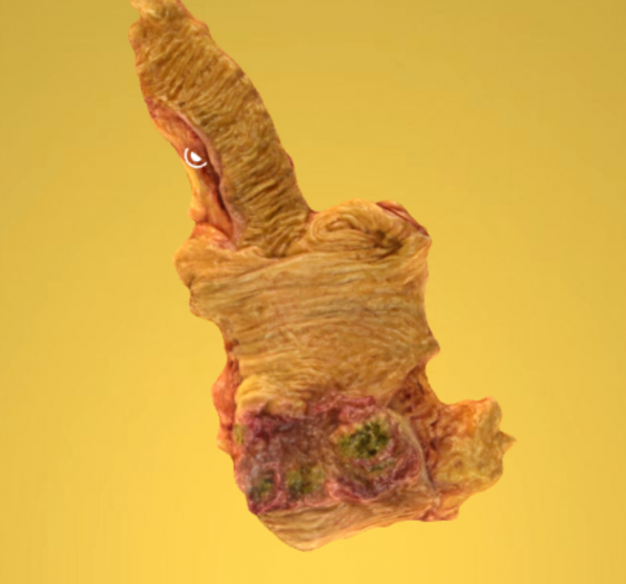 溃疡性结肠腺癌