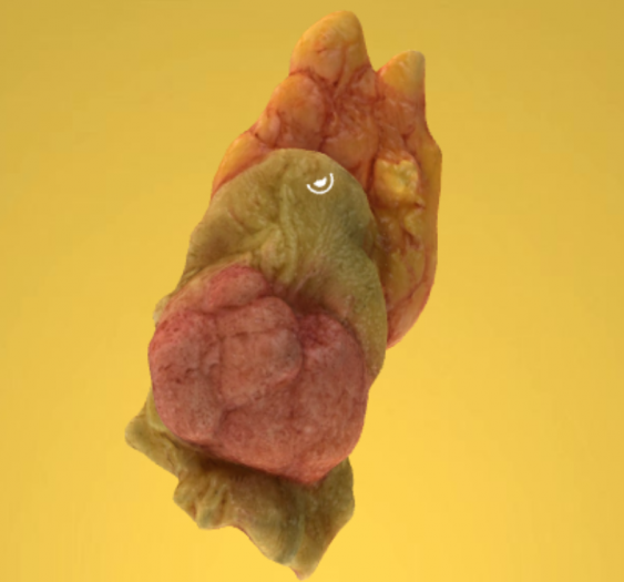 乙状结肠腺癌