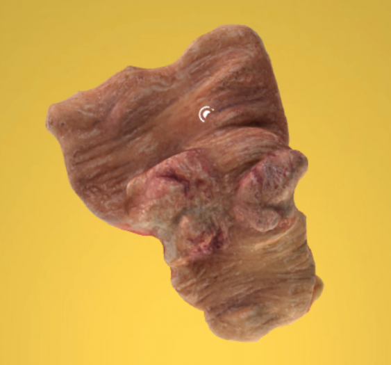 乙状结肠环形腺癌