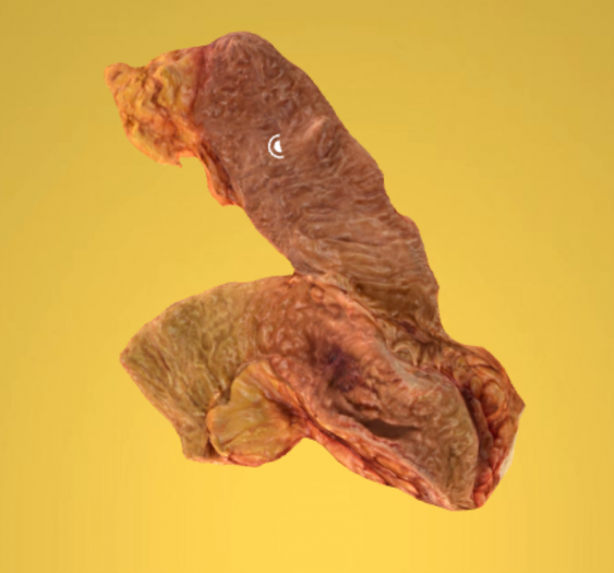 乙状结肠腺癌