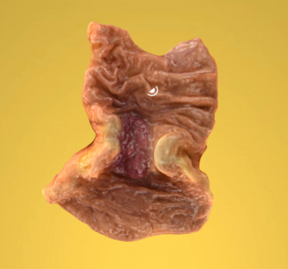乙状结肠腺癌