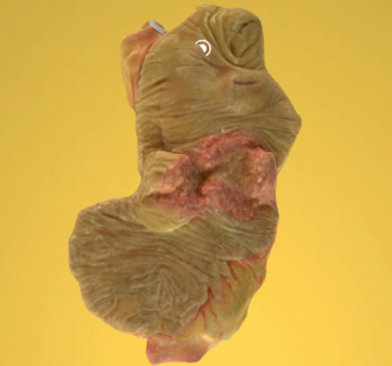 升结肠腺癌