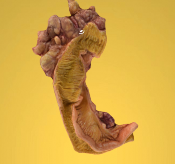 小肠神经纤维肉瘤