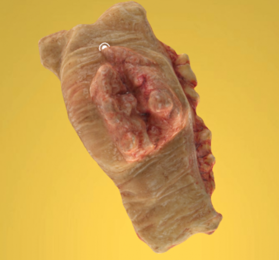 乙状结肠腺癌