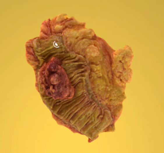 乙状结肠腺癌II级
