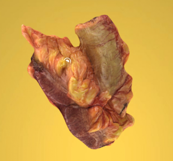 乙状结肠腺癌III级