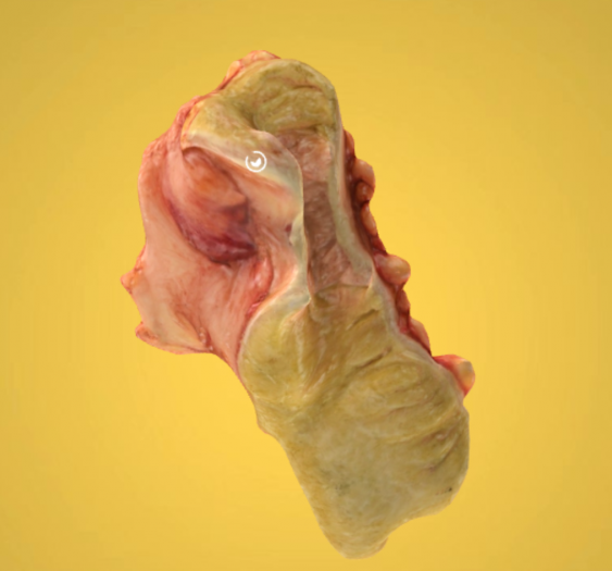直肠乙状结肠腺癌