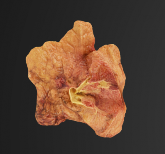 肺癌Lung Carcinoma