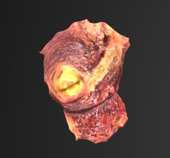 肺结核瘤Lung Tuberculoma