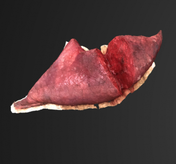 肺结节Lung Nodule