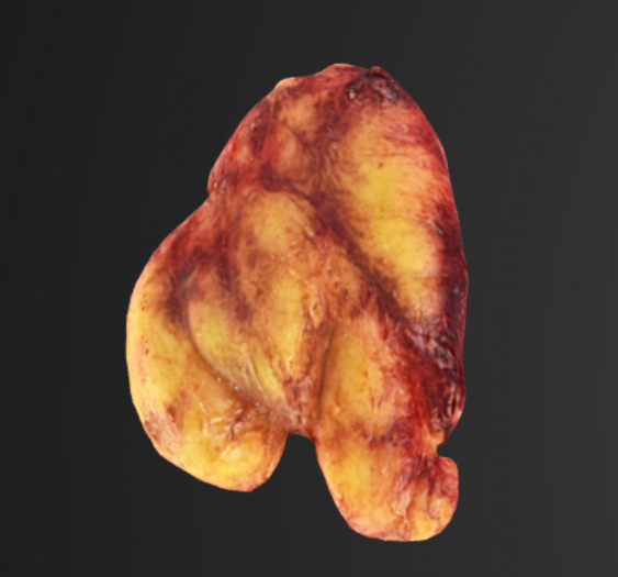 肺血肿Lung Hematoma