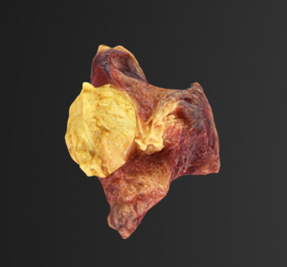 肺血肿Lung Hematoma