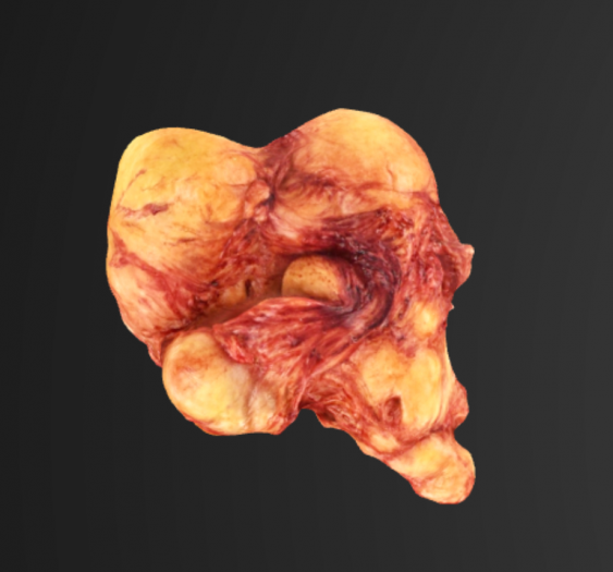 腹壁肌瘤Abdominal wall