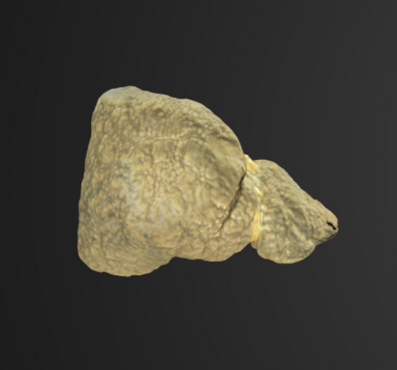 肝硬化Liver Cirrhosis
