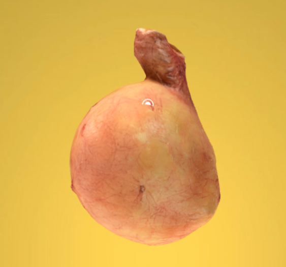 胃腺癌