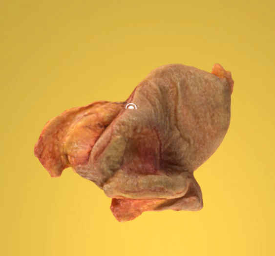 胃腺癌