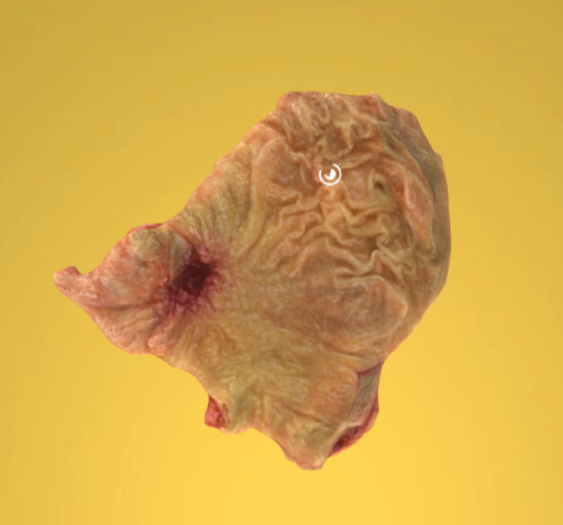 胃溃疡