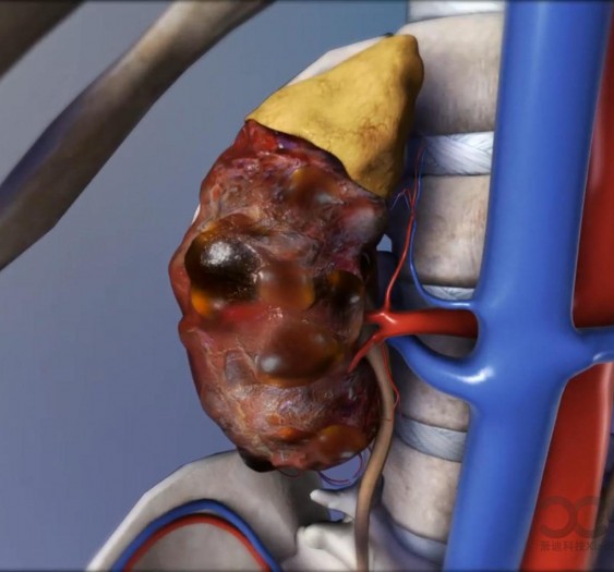 肾囊肿kidney cysts