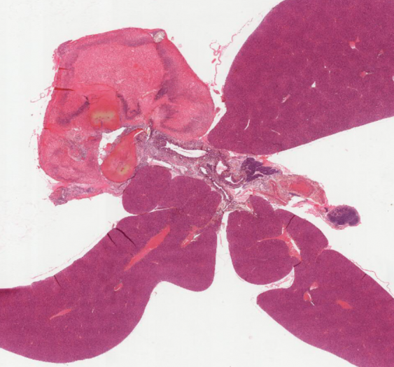 肝脏代偿性增生