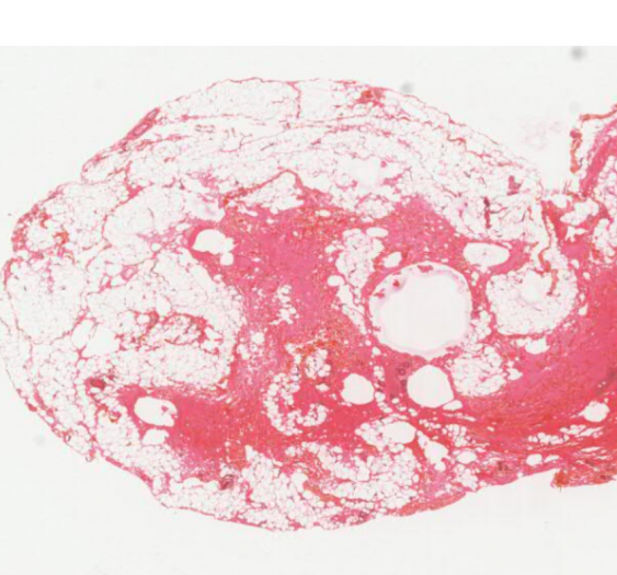 神经源性肌萎缩（AP006-2)