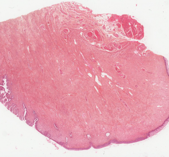 宫颈表皮样化生