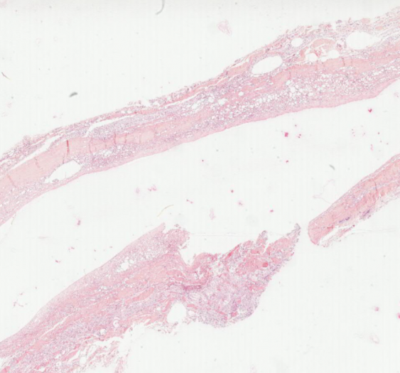 破裂的硅酮假体