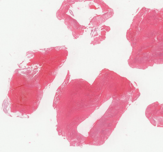 新鲜血栓（AP087)