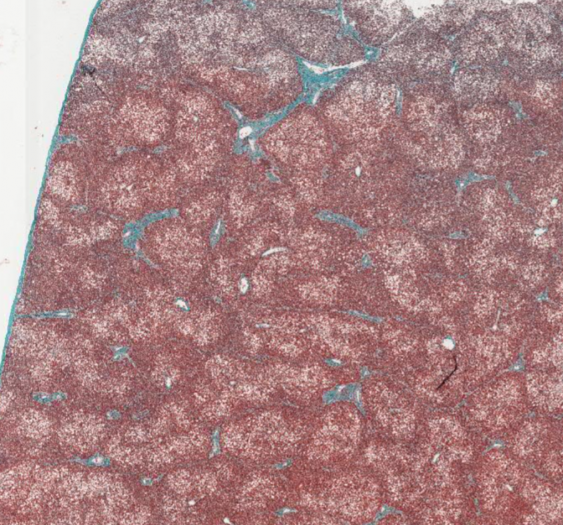 肝脂肪变性（甘油三酯）