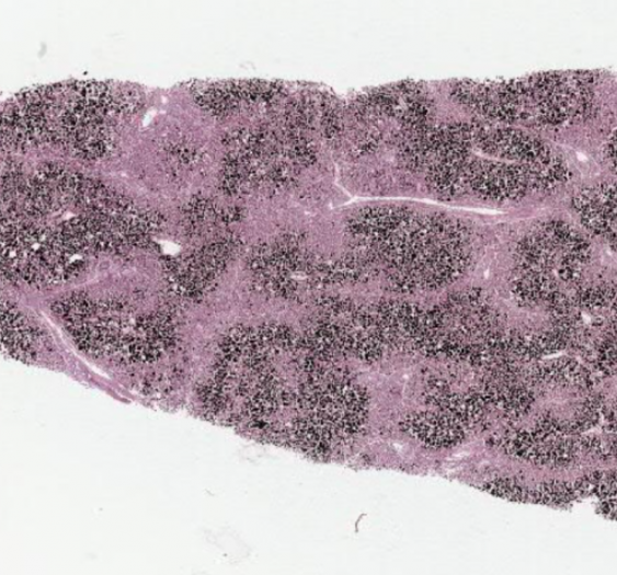 肝脂肪变性（甘油三酯）（AP016)