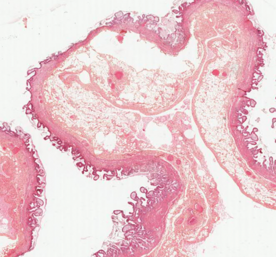 胆囊胆固醇沉积症（胆固醇）