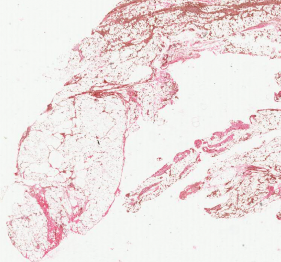 血肿（含铁血黄素 / 铁染色）（AP020)