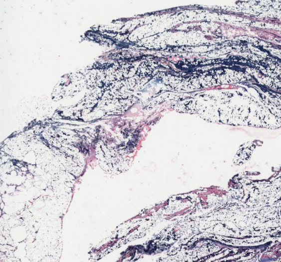 血肿（铁染色）（AP021，普鲁士蓝染色）