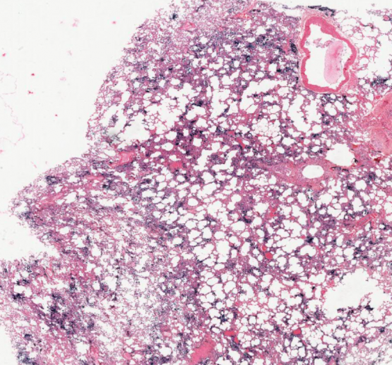 心源性肺含铁血黄素沉着症（铁染色）及炭末沉着症