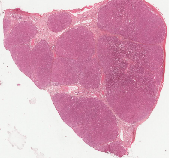 血色素沉着症（铁）引起的肝硬化