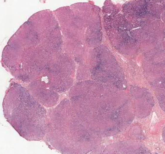 血色病性肝硬化（铁染色）（AP025，普鲁士蓝染色）