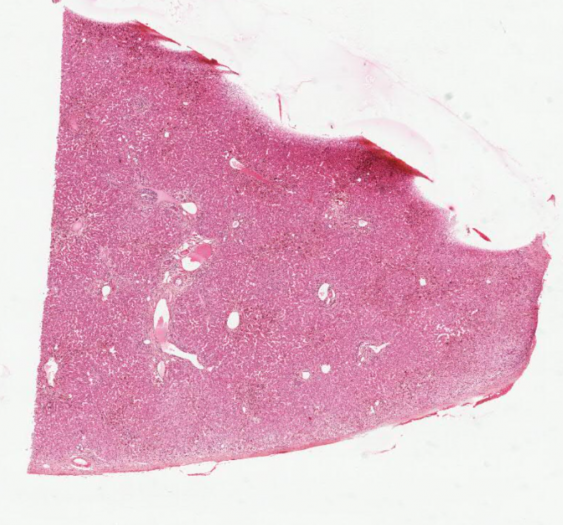 肝内胆汁淤积（胆汁淤积）