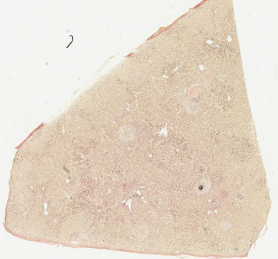 肝内胆汁淤积（胆汁）