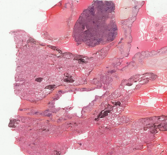 矽肺（AP029，HE 染色 & 番红染色）