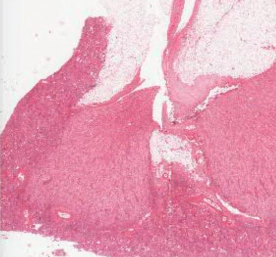 肾小球硬化症（AP044，HE 染色 & 番红染色）