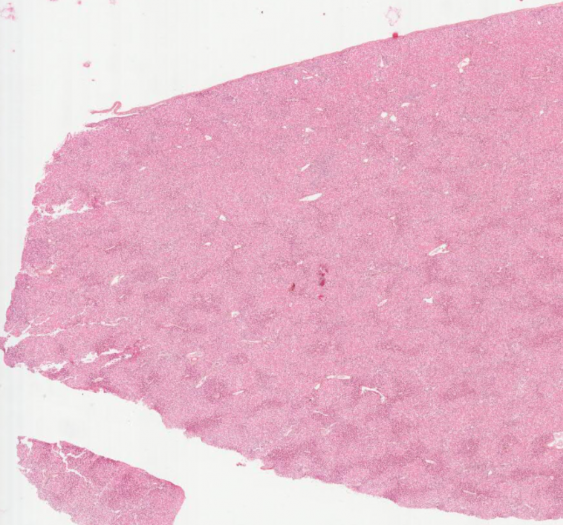 肝淀粉样变性（蛋白质沉积）