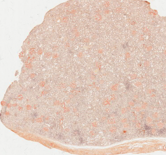 肾淀粉样变性（蛋白质）