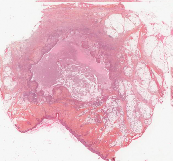 感染性藏毛囊肿