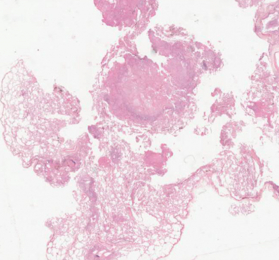肺侵袭性曲霉病