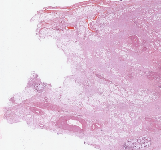 出血性慢性胃溃疡