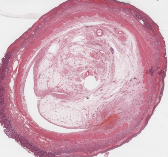 反向梅克尔憩室