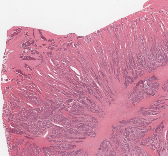 盲肠黏膜下微类癌