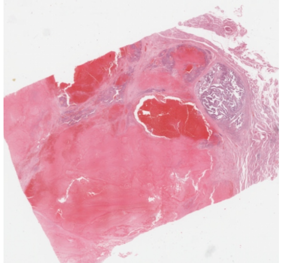 混合性生殖细胞肿瘤（以绒毛膜癌为主，伴有单个胚胎性癌灶）